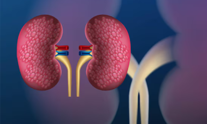 Kanker ginjal merupakan salah satu jenis kanker yang cukup umum terjadi.